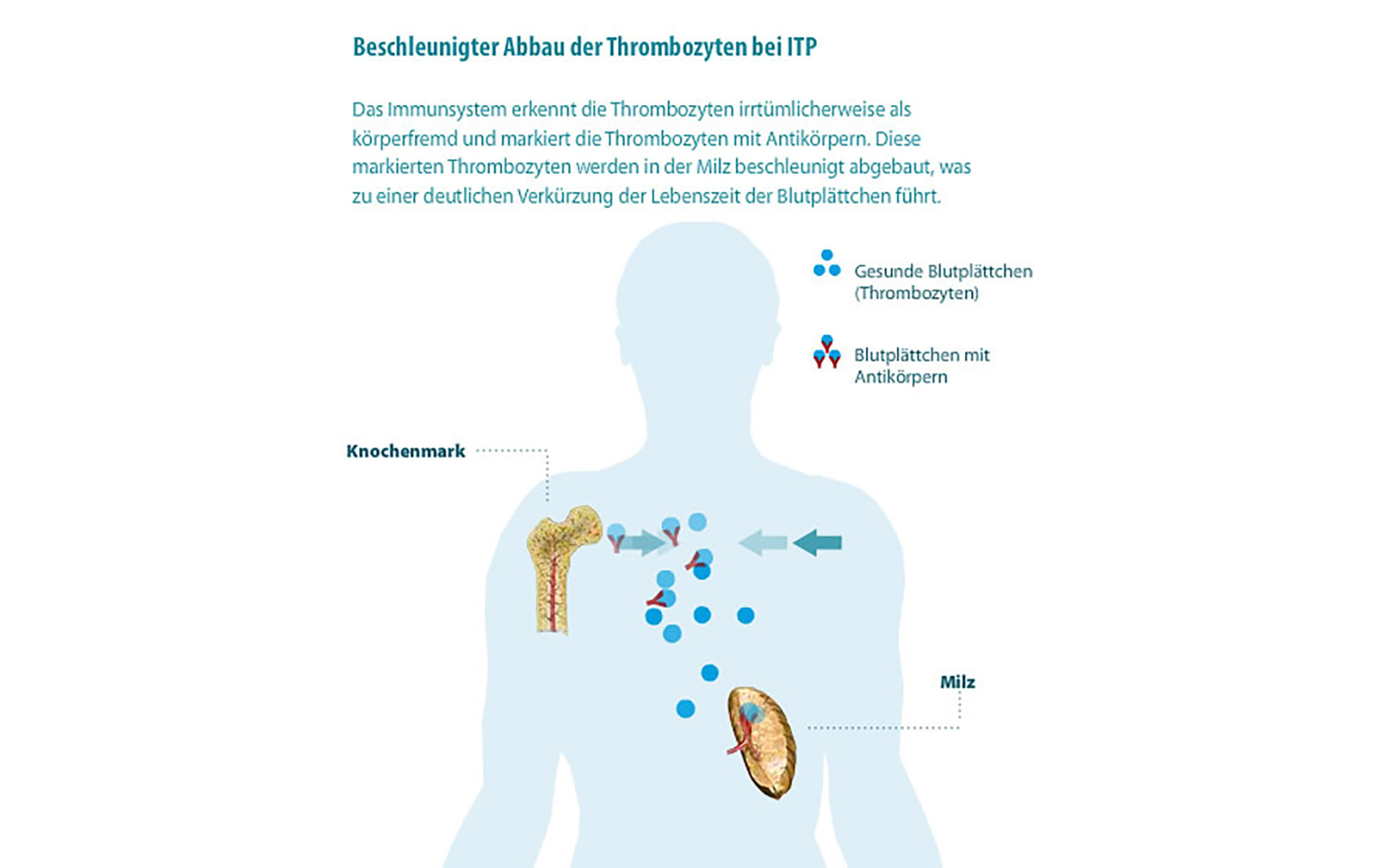 ITP - Idiopathische Thrombozytopenische Purpura